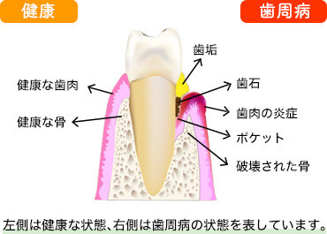 健康な状態と歯周病の状態のイラスト