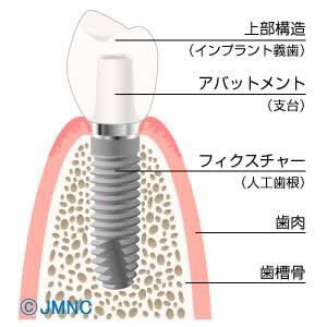 インプラントのイラスト1