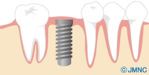 インプラントのイラスト2