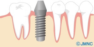 インプラントのイラスト3