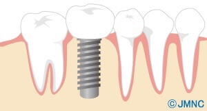 インプラントのイラスト4