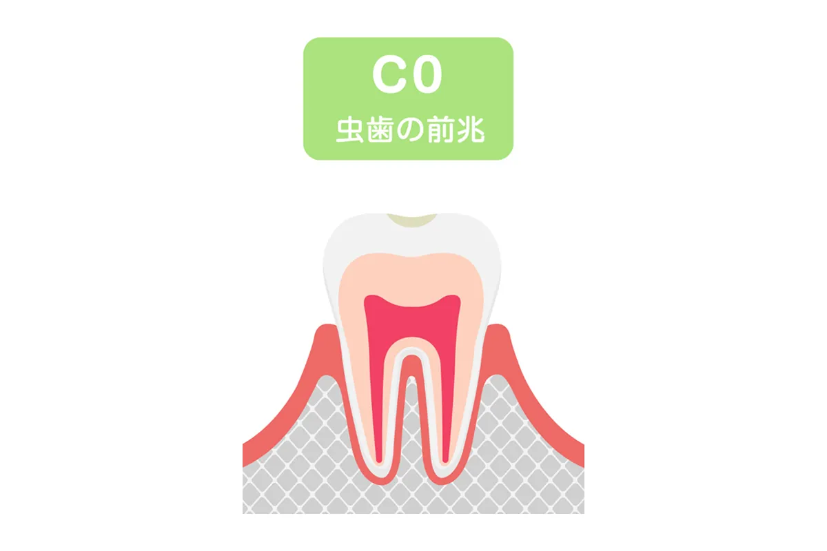 初期虫歯（C0）