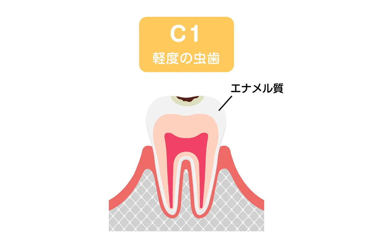 エナメル質の虫歯（C1）