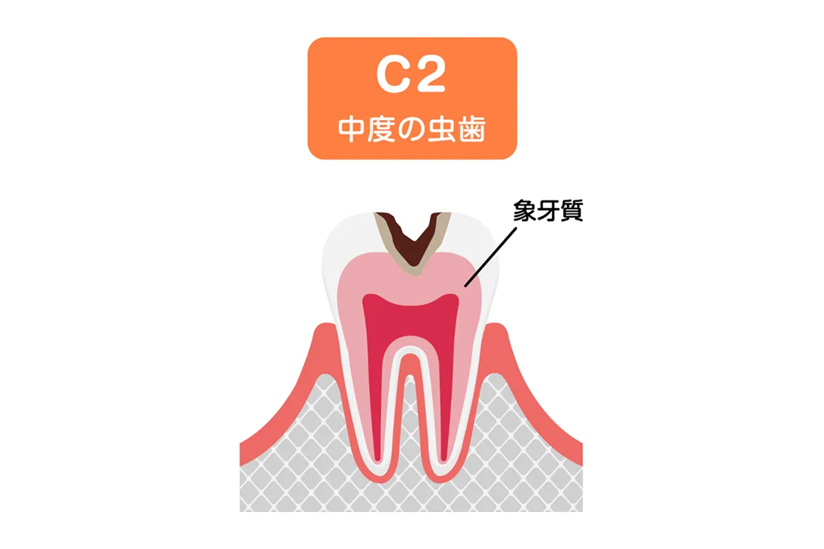 象牙質に達した虫歯（C2）