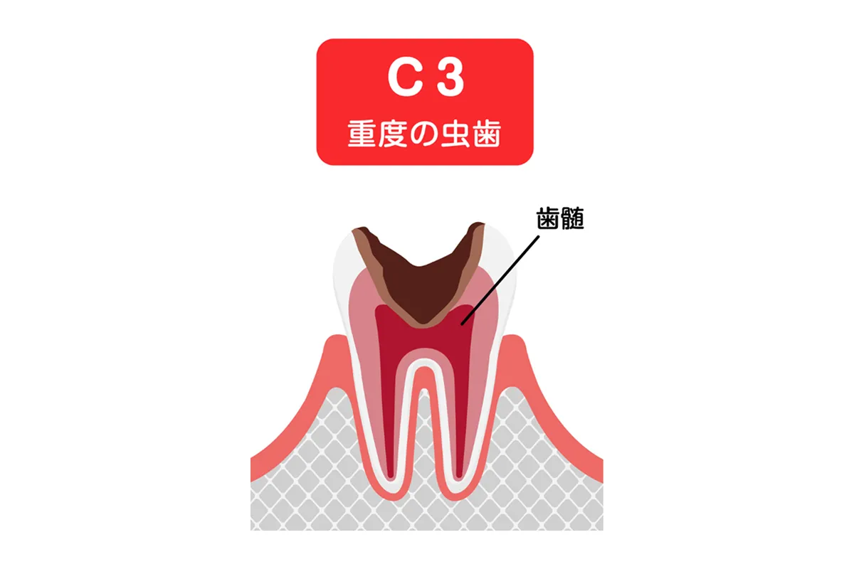 神経に達した虫歯（C3）