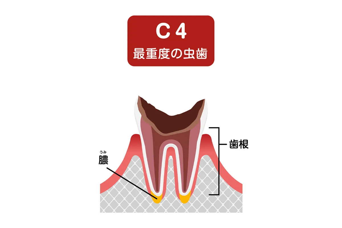 歯の根だけが残った虫歯（C4）