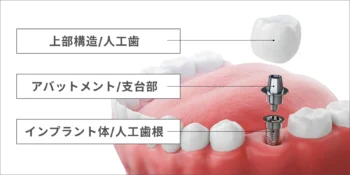 インプラントの構造