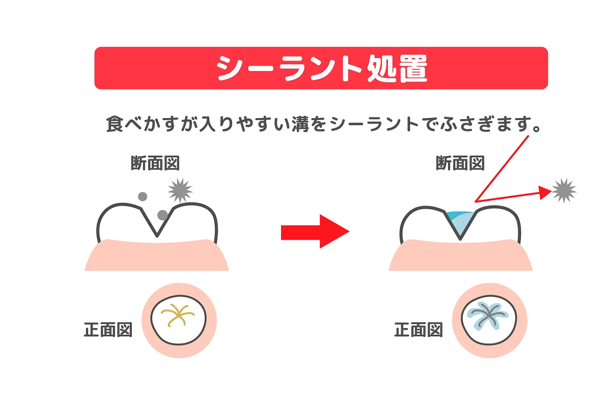 シーラントのイメージ