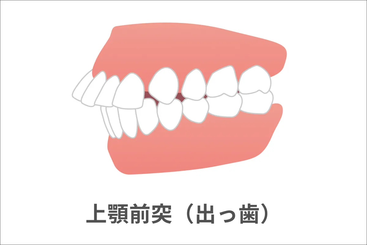 上顎前突（じょうがくぜんとつ）・出っ歯