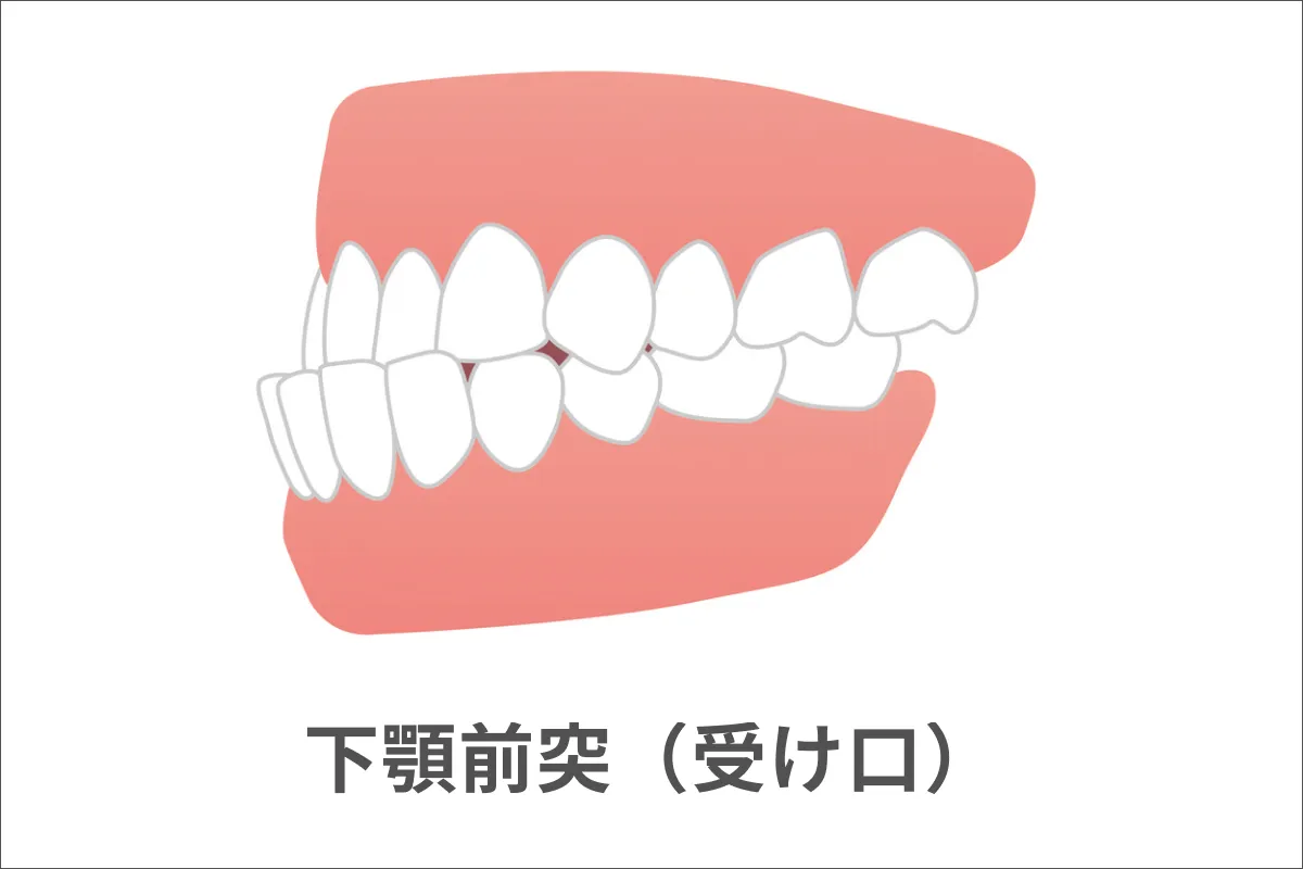 下顎前突（かがくぜんとつ）・受け口