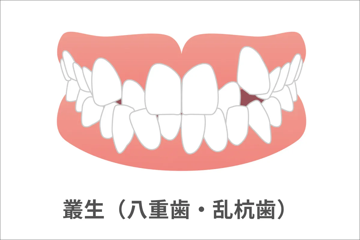 叢生（そうせい）・乱ぐい歯