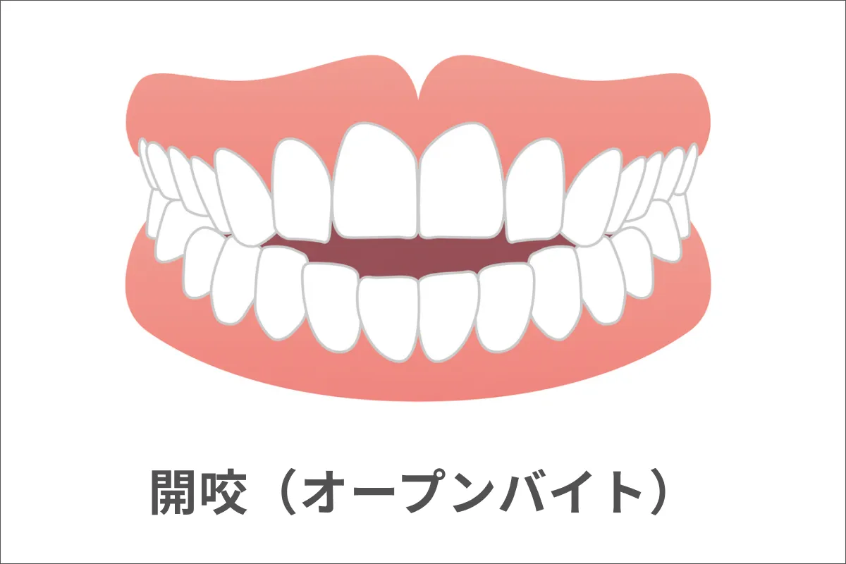 開咬（かいこう）・オープンバイト