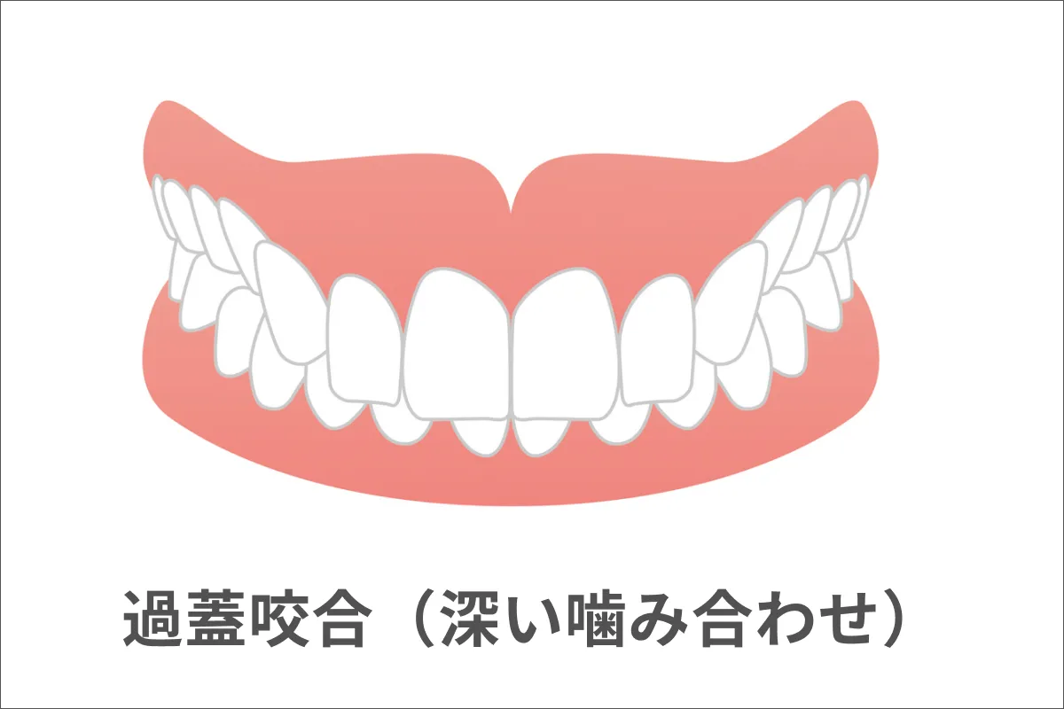 過蓋咬合（かがいこうごう）