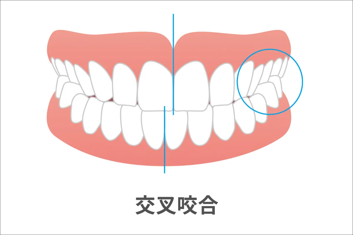 交差咬合（こうさこうごう）